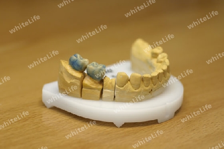Zahnlabor: Gips-Modell